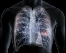cigs可引发吸烟者肺气肿相同的肺部变化