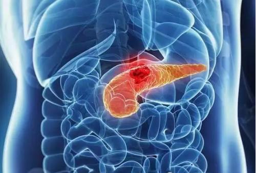 MD Anderson研究证实蛋白质是最常见类型胰腺癌的潜