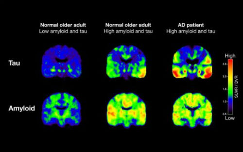  Neuron：阿尔兹海默症致病蛋白PET成像，指示病情发展