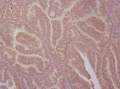 CancerRes：鉴别出子宫内膜癌中的关键蛋白或有望帮助开发新型靶向性疗法