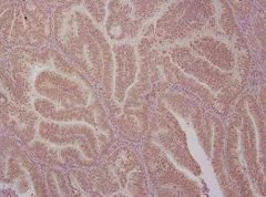 CancerRes：鉴别出子宫内膜癌中的关键蛋白或有望帮助开发新型靶向性疗法