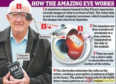 人工视网膜植入仿生系统可让黄斑变性患者恢复视力