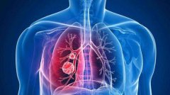 研究人员确定了可以预测肺癌是否可能扩散的标志物