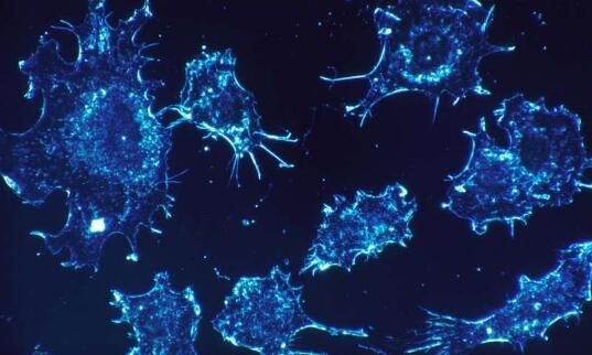 ClinCancerRes：新成果！科学家识别出能指示子宫内膜癌患者不良预后的新型生物标志物