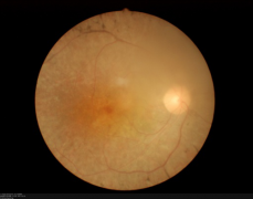 中因科技基因检测真空抽滤预防视网膜类眼病病发