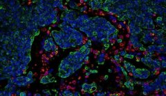 CancerDiscov：揭示循环肿瘤细胞靶向扩散到远端器官的分子机制
