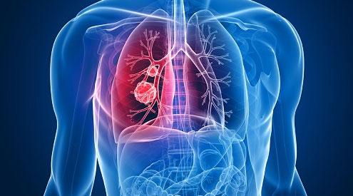 科学家确定了与肺癌和黑色素瘤进展有关的蛋白