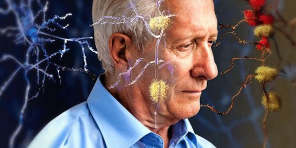 唾液生物标志物可以帮助阿尔茨海默氏病的早期